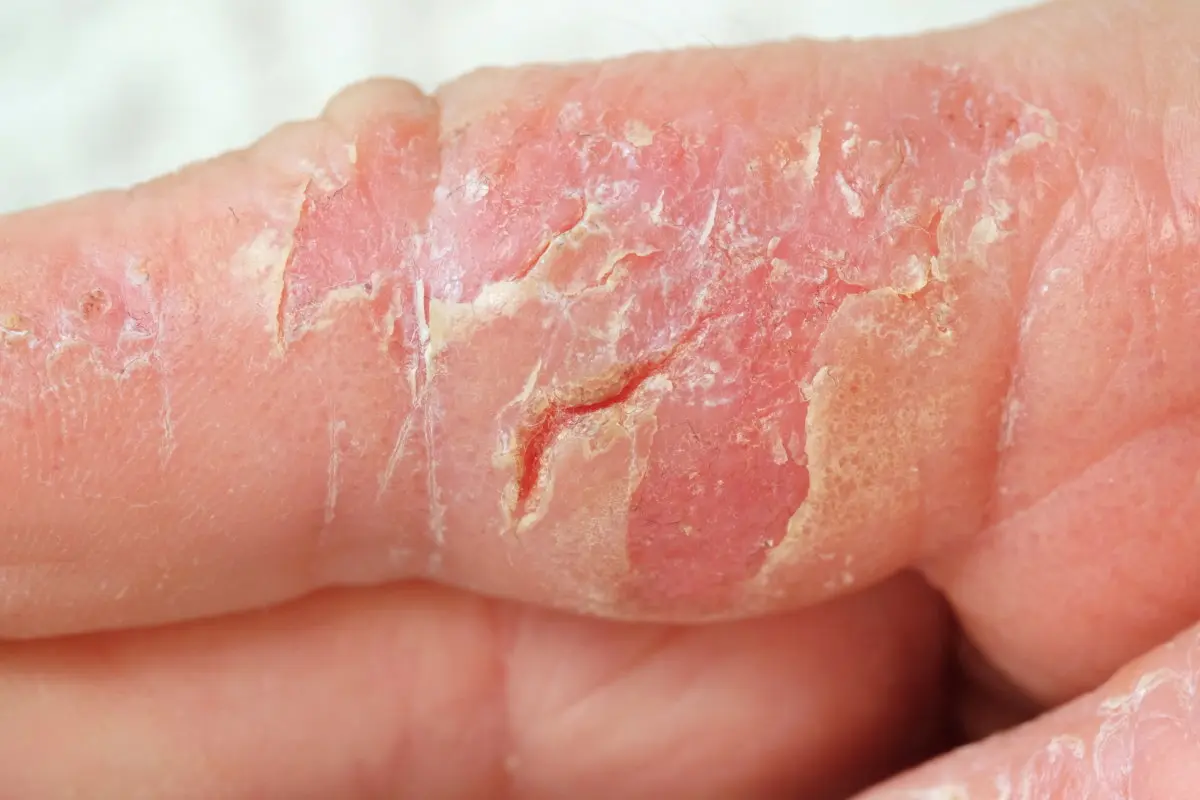 ekzem finger