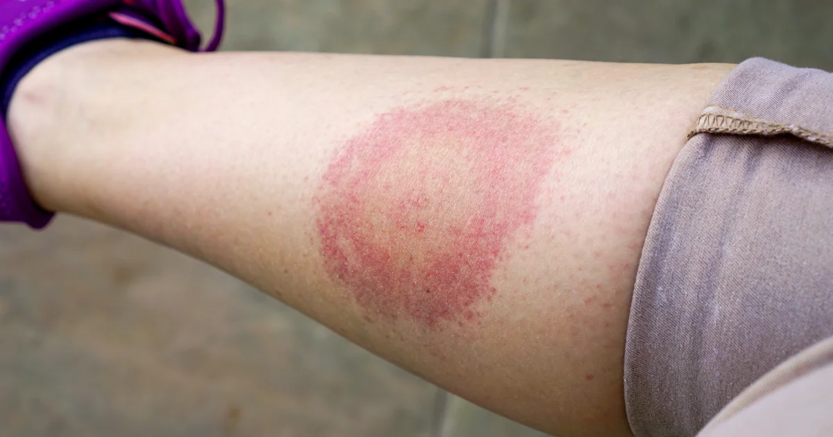 borreliose zecken